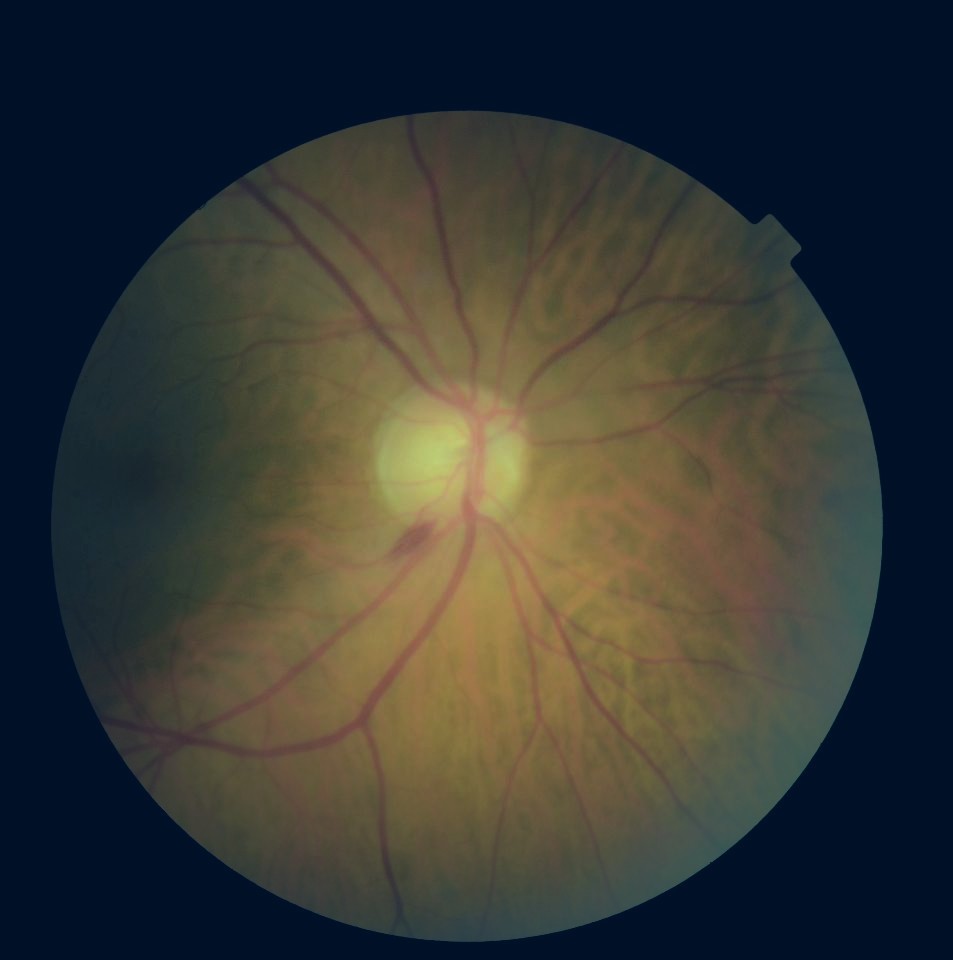 Retina image A