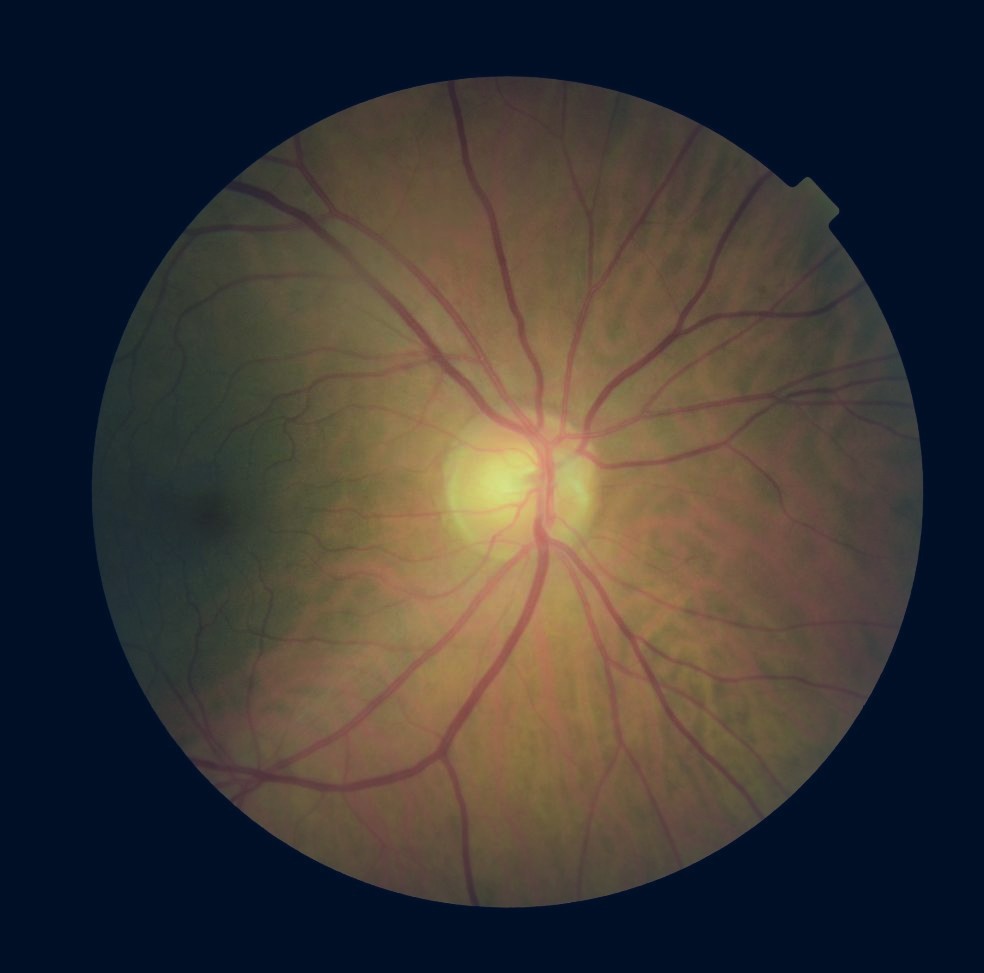 Retina image B